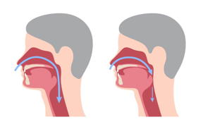 sleep apnea sleep apnea